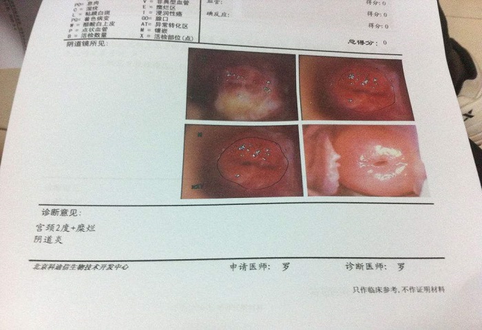 宮頸糜爛治療